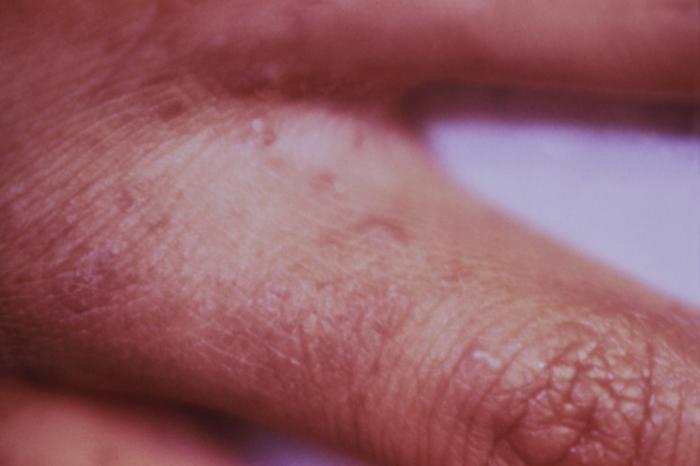 scabies images