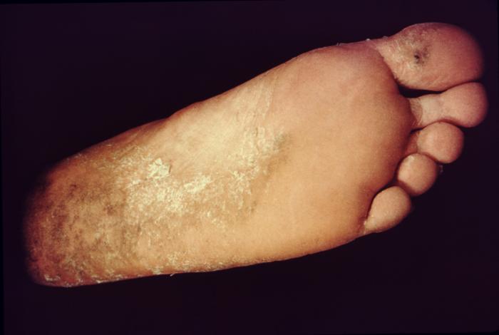 Athletes Foot. This patient presented with ringworm 
