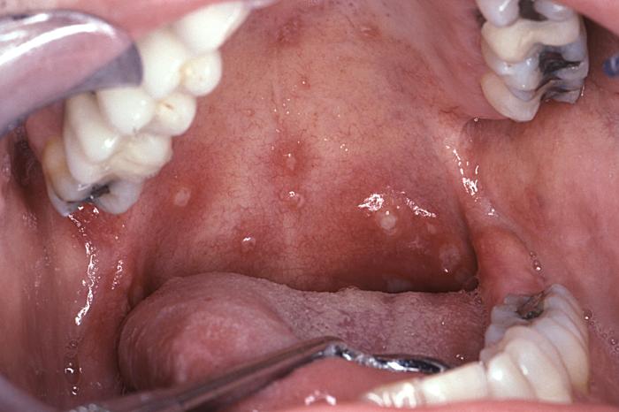 mouth lesions pictures