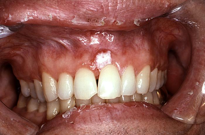 Oral Cancer Mouth