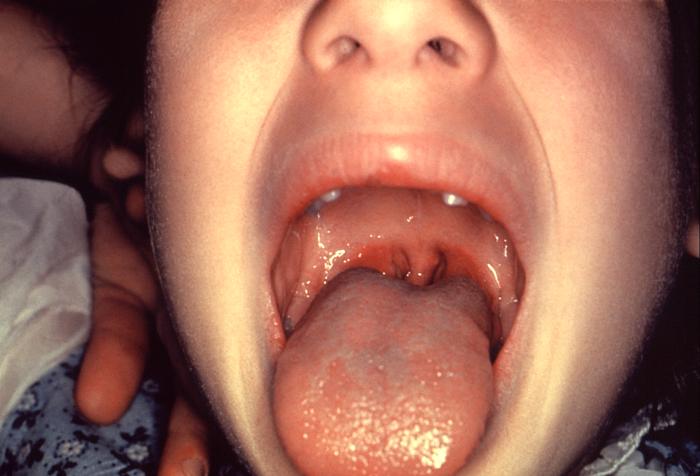 Hardin MD : Strep Infections - Medical Information + Pictures