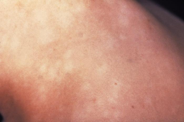 syphilis skin rash