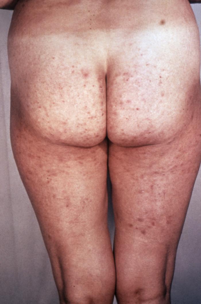 This syphilis patient presented with a “roseola rash”, similar to that of 
