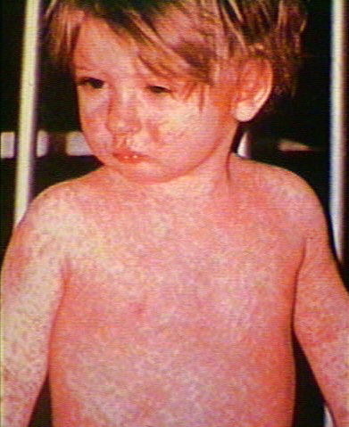 Chicken Pox Rash and Picture with information on Vaccine