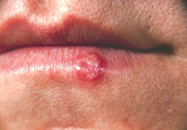 herpes sores pictures