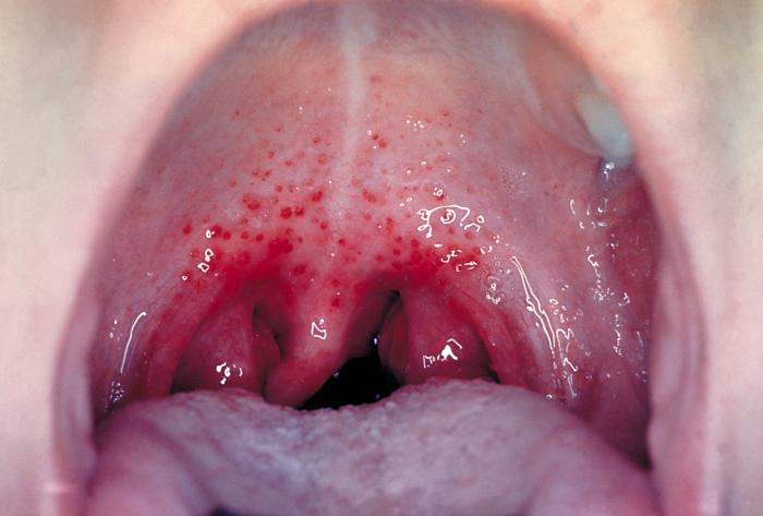 Red Spots In Throat 3