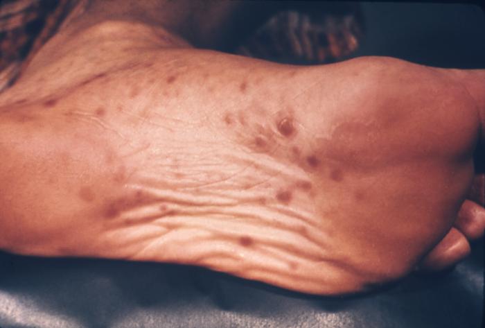 Foot rash - check medical symptoms at RightDiagnosis