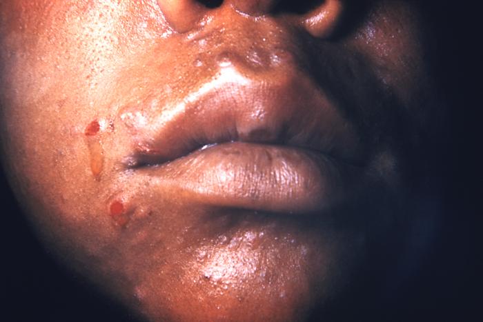 This patient presented with secondary syphilitic lesions on the face.