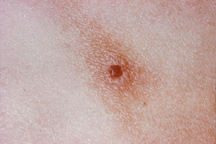 Gonorrhea Picture : Skin Lesion (Hardin MD / CDC)