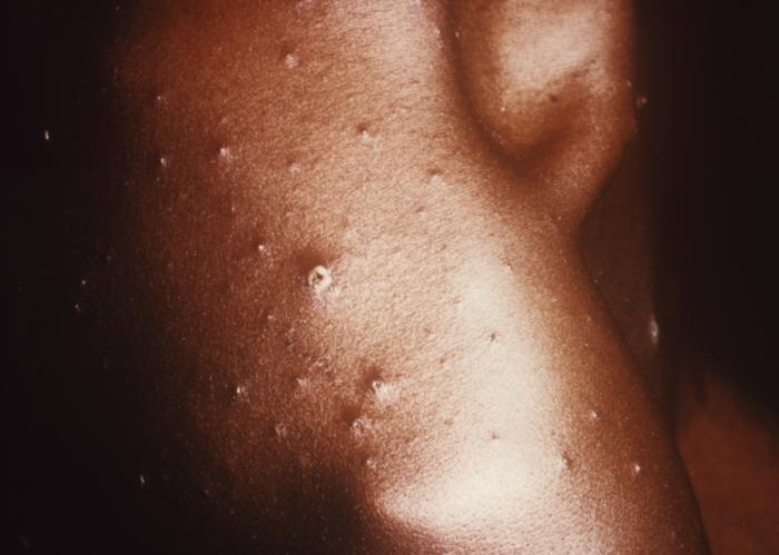 chicken pox rash pictures