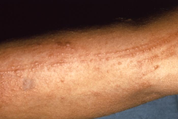 What is poison oak rash?