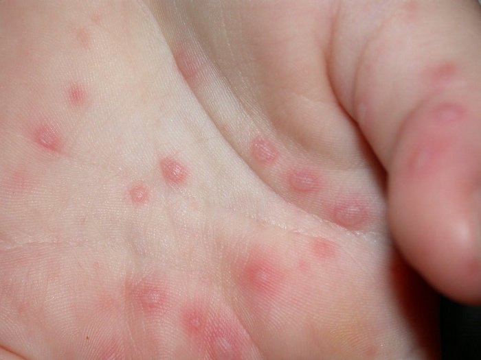 hand foot and mouth disease rash pictures