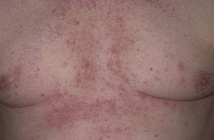 seborrheic dermatitis on chest
