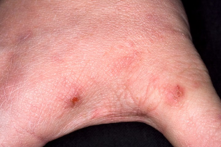 scabies pictures #10