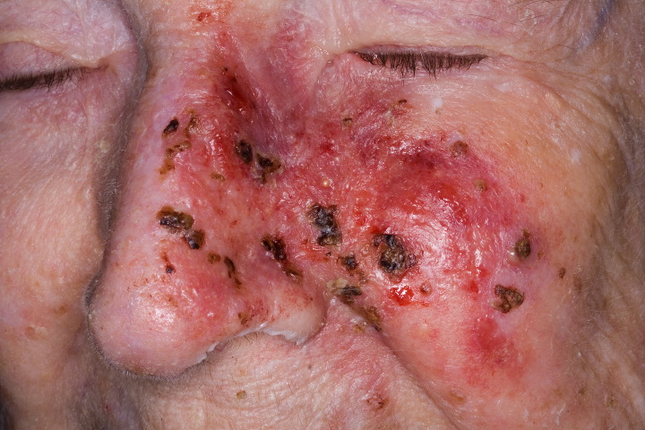 skin cancer face
