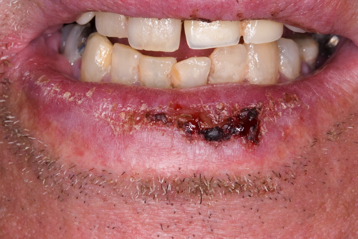 Cellulitis Of The Mouth 113