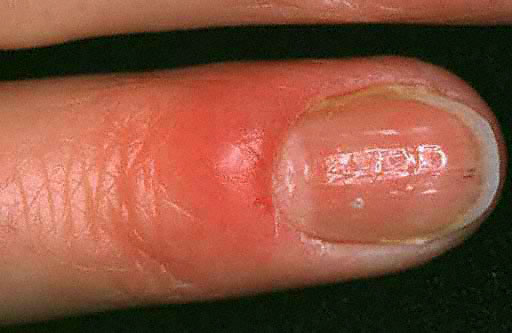 10 Nail Symptoms and What They Mean for Your Health