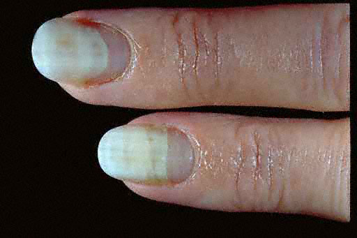 Nail Bed Problems Point to Vascular Issues in Glaucoma ...