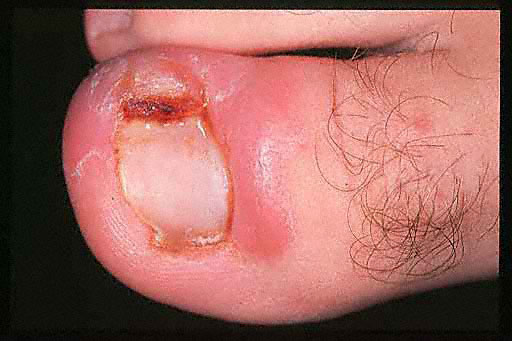 toenail diseases