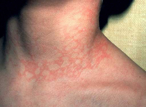 The Basics on Fifth Disease - WebMD