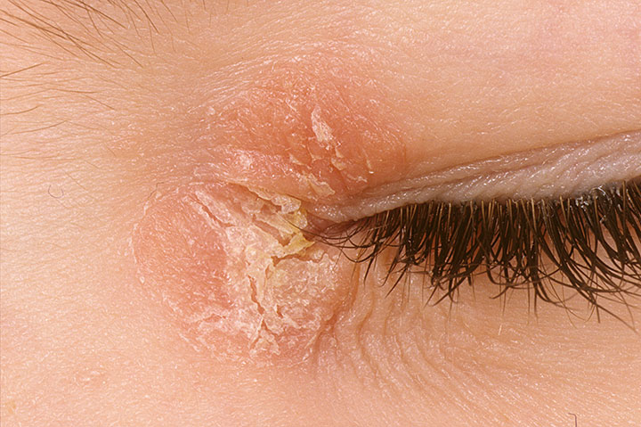 Dry Patch Of Skin Above Eyelids