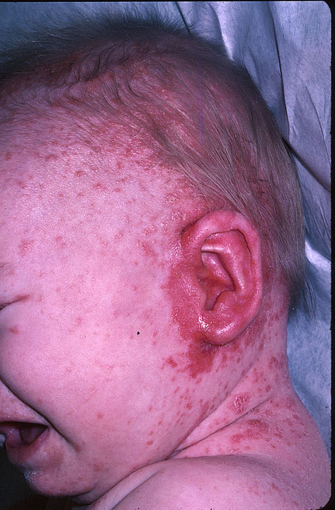 Seborrheic Dermatitis - familydoctor.org