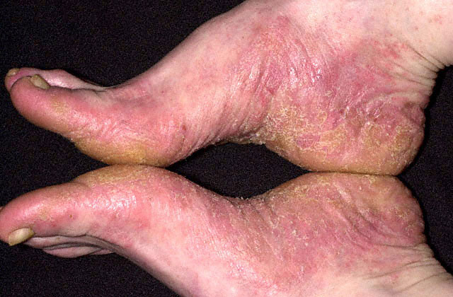 contact dermatitis rash. Allergic Contact Dermatitis