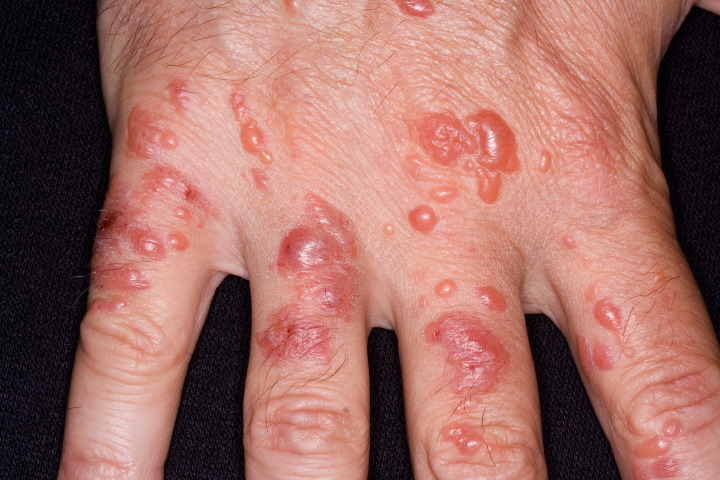mild poison sumac rash. Bothersome rash is known