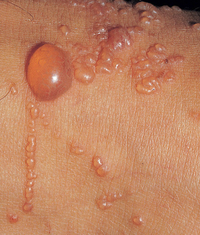 Skin Lesions: Vesicle