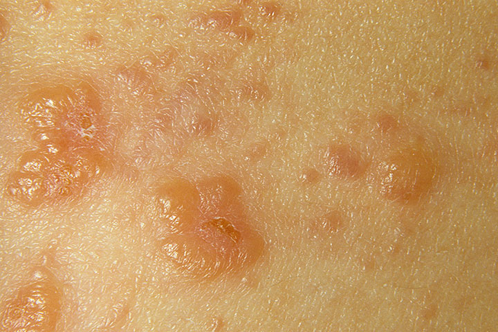Dermatitis herpetiformis / Ziekte van Dühring - Huidarts.com