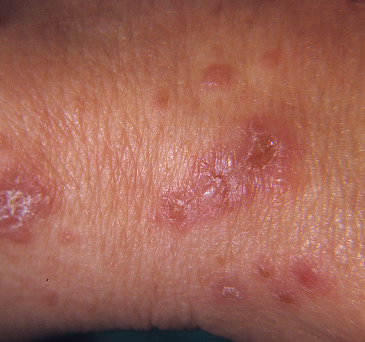 Dermatitis herpetiformis: MedlinePlus Medical Encyclopedia