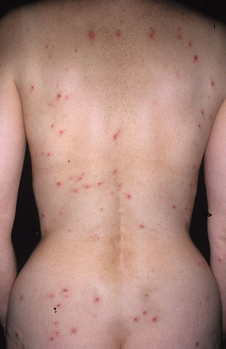 Dermatitis herpetiformis | DermNet New Zealand