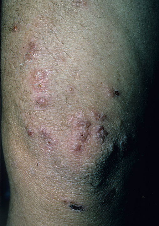 dermatitis herpetiformis pictures #11