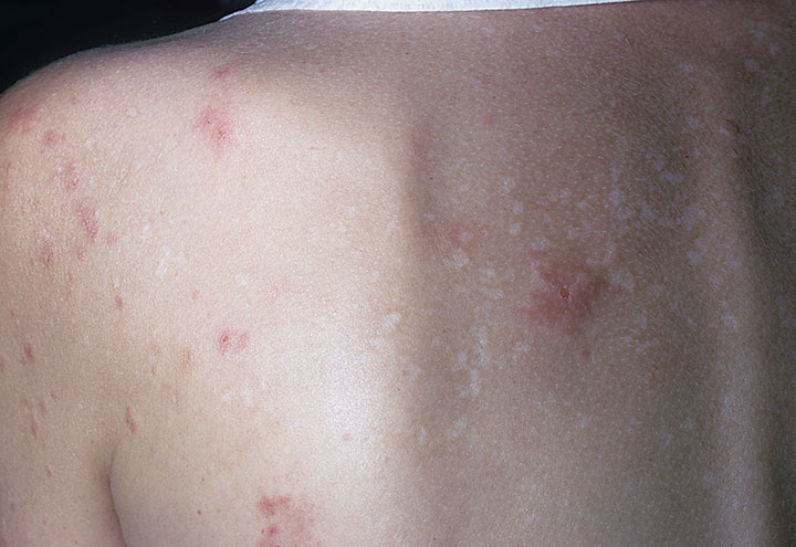 Dermatitis Herpetiformis | NIDDK
