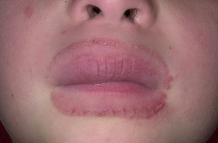 eczema around the lips - MedHelp
