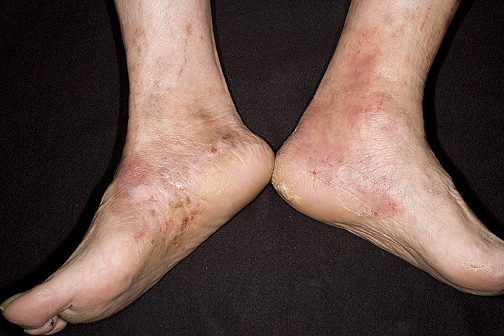 foot eczema