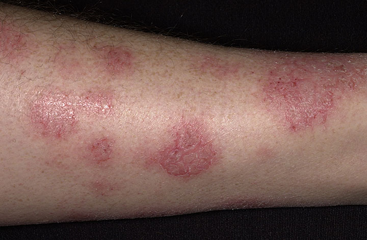 Eczema Symptoms & Signs | NEOSPORIN®