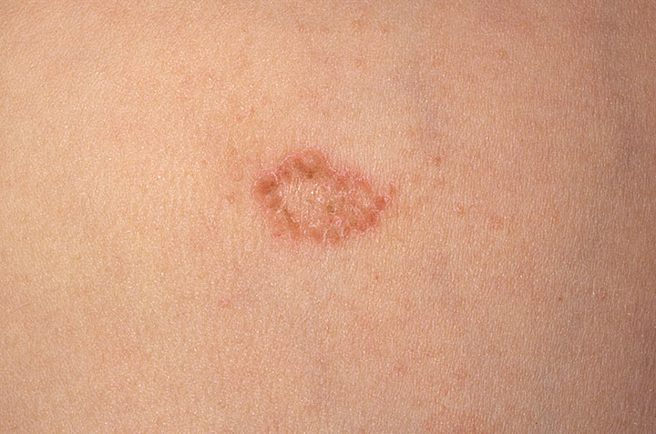 dermnet eczema