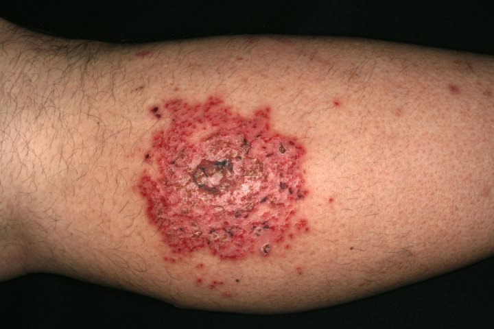Skin Disease Pictures from DermNet.com - Hardin MD