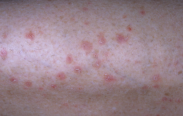 Flea Bites on Humans with Pictures