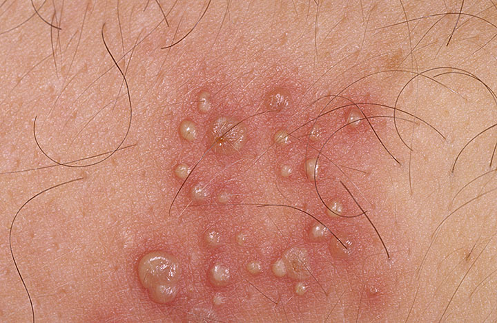Images Of Herpes