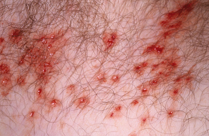 Herpes on Scrotum - Herpes - MedHelp