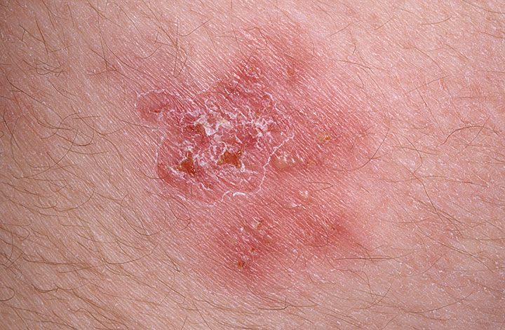 Herpes Simplex Virus Type 2 Picture Image on MedicineNet.com