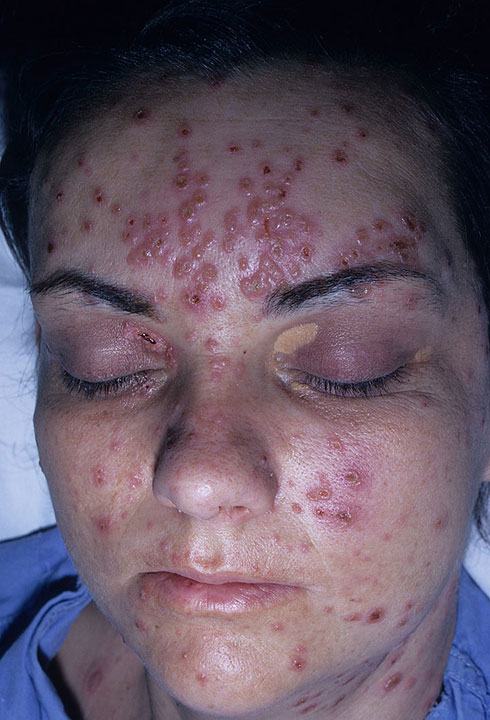 herpes facial rash