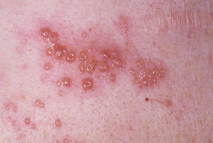 Herpes Zoster Picture Image on MedicineNet.com