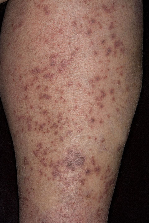 Herpes on my lower leg - STDs - MedHelp