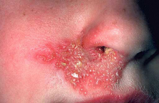 herpes pictures in mouth. cold sore