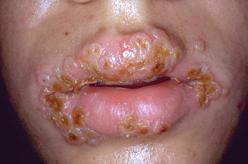 herpes simplex mouth. cold sore
