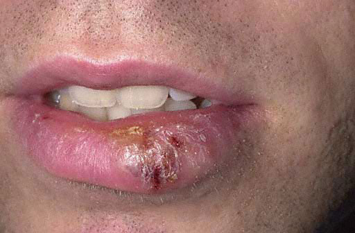 herpes pictures in mouth. cold sore