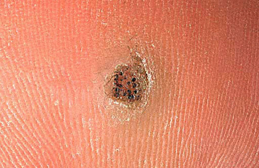 How to Get Rid of Plantar Warts - Removal and Treatment ...